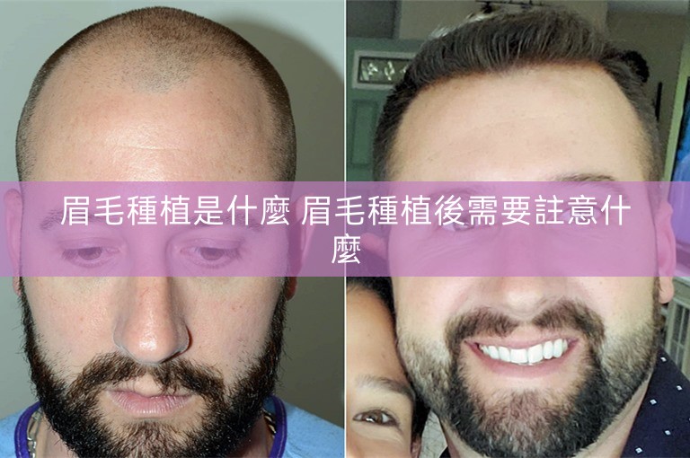 眉毛種植是什麼 眉毛種植後需要註意什麼