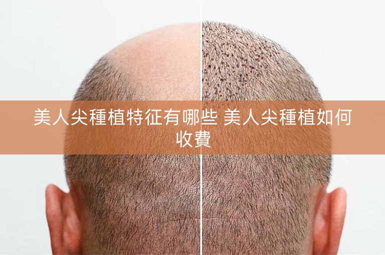 美人尖種植特征有哪些 美人尖種植如何收費