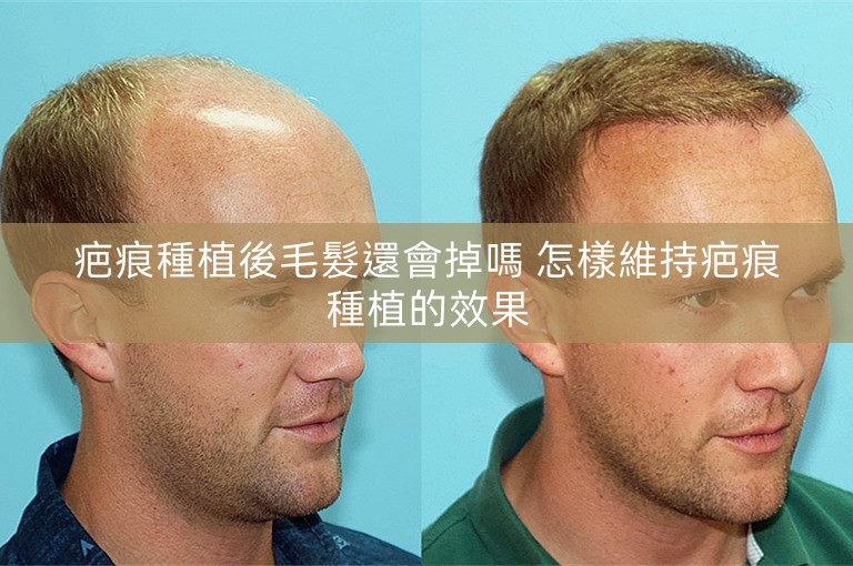 疤痕種植後毛髮還會掉嗎 怎樣維持疤痕種植的效果