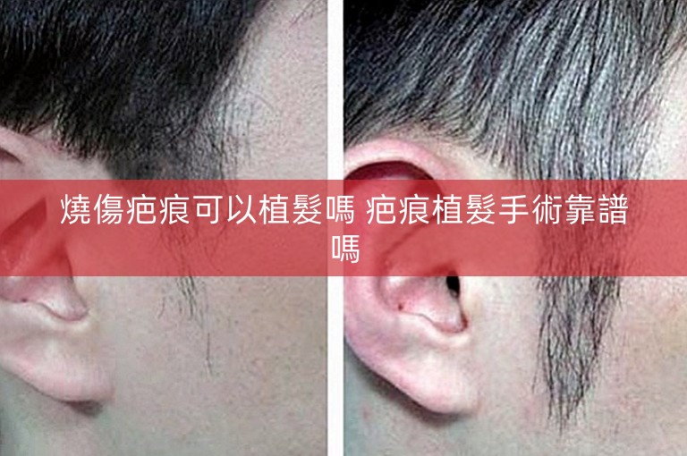 燒傷疤痕可以植髮嗎 疤痕植髮手術靠譜嗎