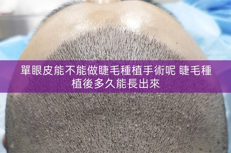 單眼皮能不能做睫毛種植手術呢 睫毛種植後多久能長出來