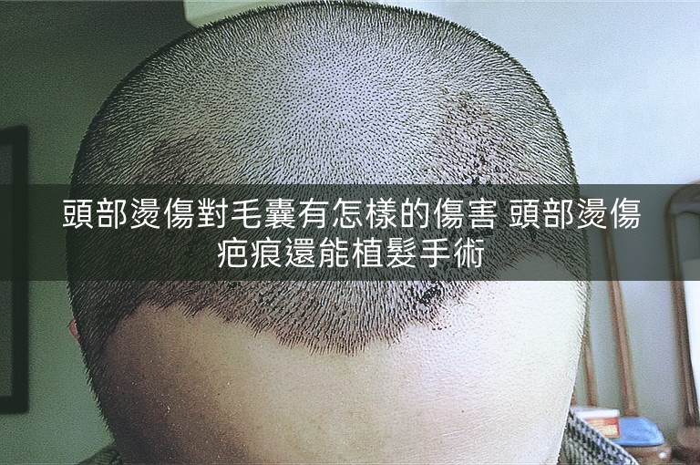 頭部燙傷對毛囊有怎樣的傷害 頭部燙傷疤痕還能植髮手術