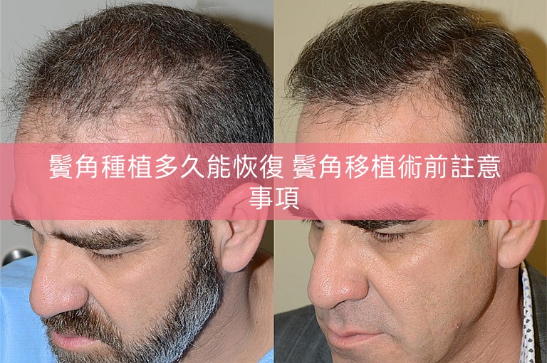 鬢角種植多久能恢復 鬢角移植術前註意事項