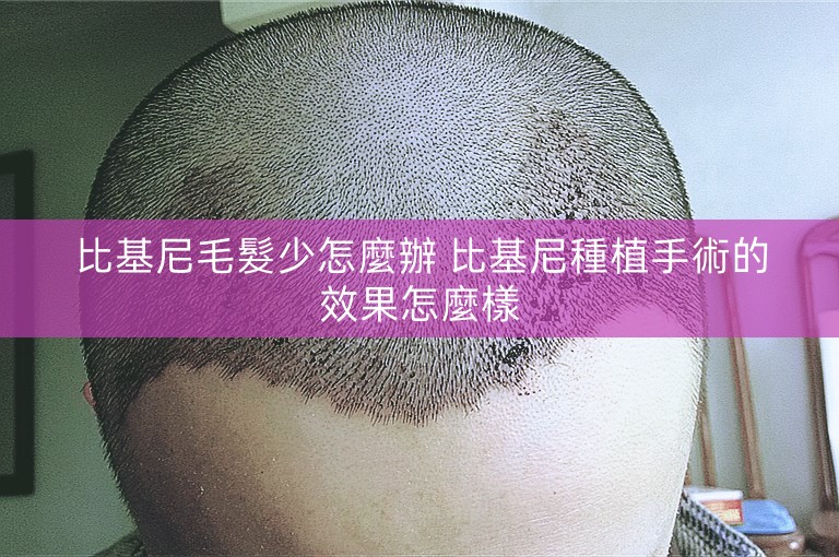 比基尼毛髮少怎麼辦 比基尼種植手術的效果怎麼樣