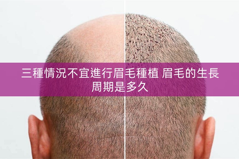 三種情況不宜進行眉毛種植 眉毛的生長周期是多久