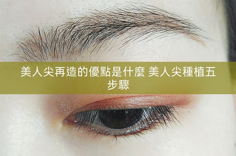 美人尖再造的優點是什麼 美人尖種植五步驟