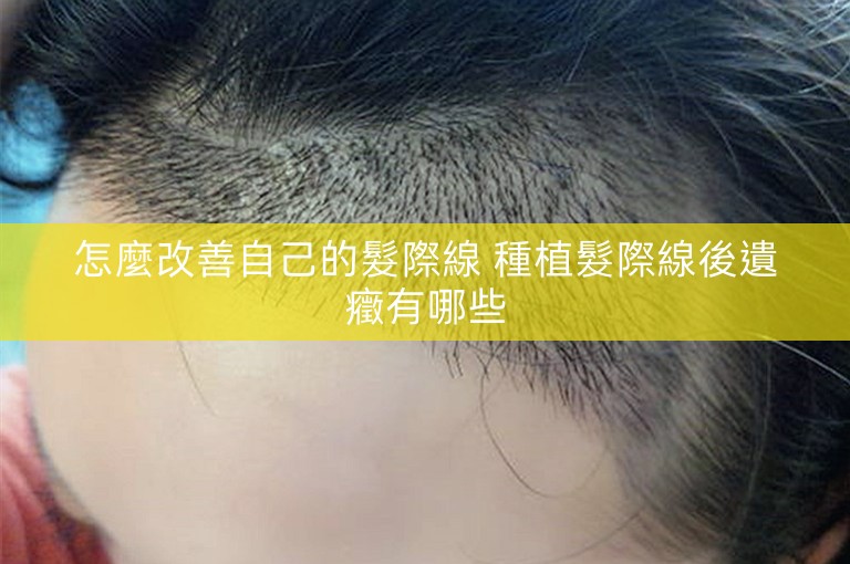 怎麼改善自己的髮際線 種植髮際線後遺癥有哪些 怎麼改善自己的髮際線 種植髮際線後遺癥有哪些