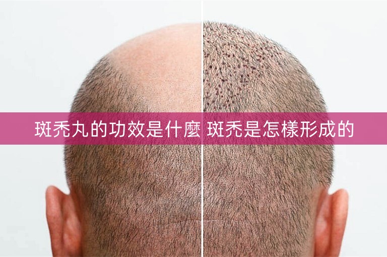 斑禿丸的功效是什麼 斑禿是怎樣形成的