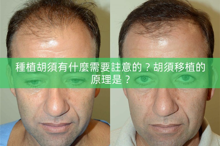 種植胡須有什麼需要註意的?胡須移植的原理是? 種植胡須有什麼需要註意的?胡須移植的原理是?