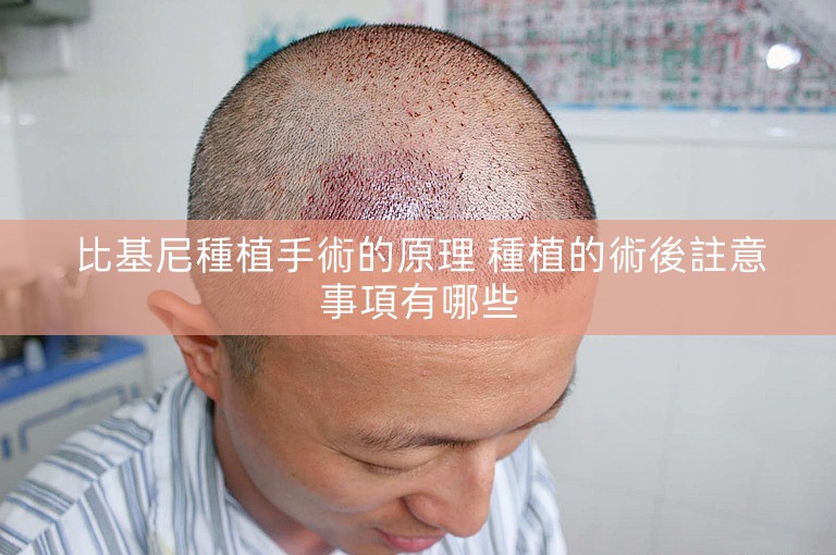 比基尼種植手術的原理 種植的術後註意事項有哪些