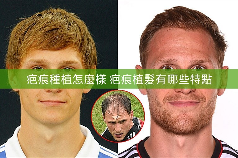 疤痕種植怎麼樣 疤痕植髮有哪些特點