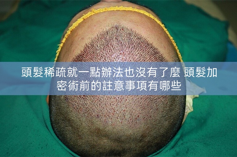 頭髮稀疏就一點辦法也沒有了麼 頭髮加密術前的註意事項有哪些