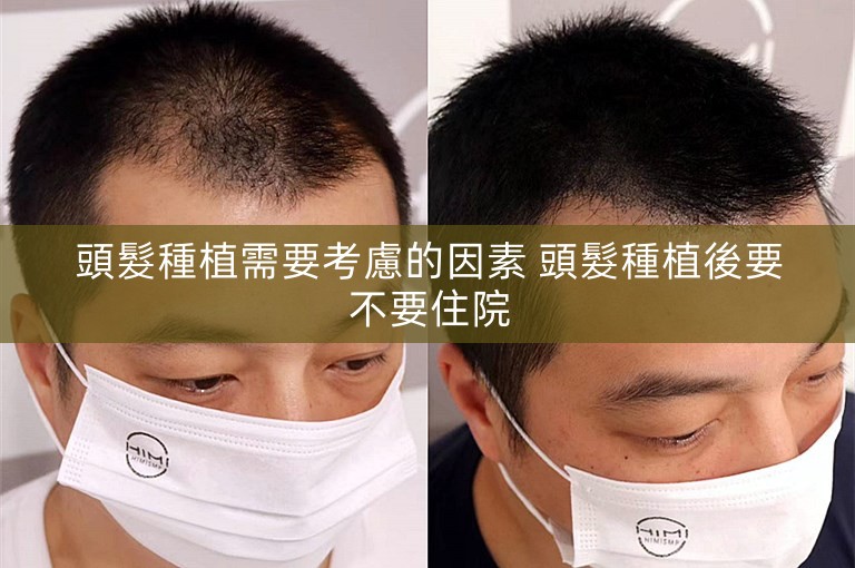 頭髮種植需要考慮的因素 頭髮種植後要不要住院