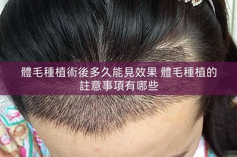 體毛種植術後多久能見效果 體毛種植的註意事項有哪些
