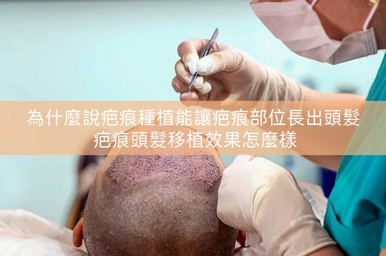 為什麼說疤痕種植能讓疤痕部位長出頭髮 疤痕頭髮移植效果怎麼樣