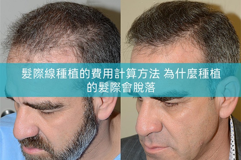 髮際線種植的費用計算方法 為什麼種植的髮際會脫落