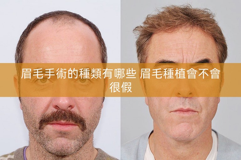 眉毛手術的種類有哪些 眉毛種植會不會很假