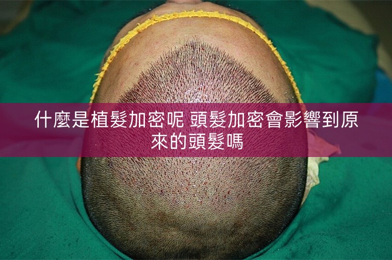 什麼是植髮加密呢 頭髮加密會影響到原來的頭髮嗎