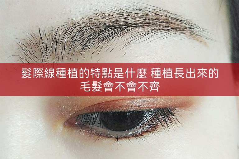 髮際線種植的特點是什麼 種植長出來的毛髮會不會不齊