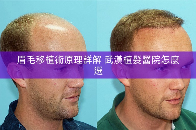 眉毛移植術原理詳解 武漢植髮醫院怎麼選