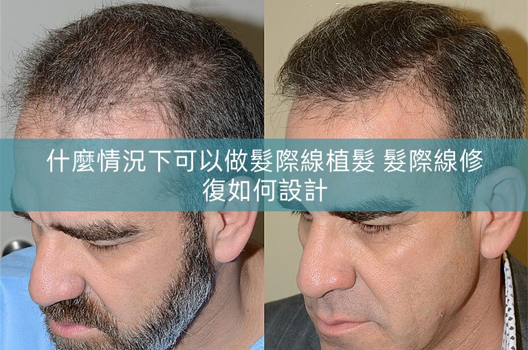 什麼情況下可以做髮際線植髮 髮際線修復如何設計 什麼情況下可以做髮際線植髮 髮際線修復如何設計