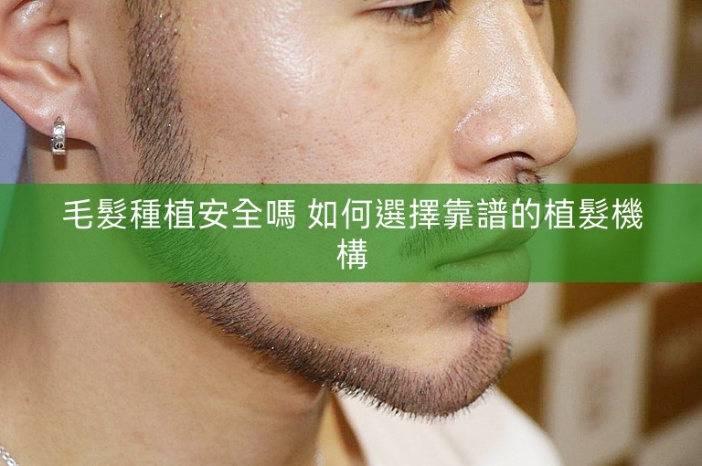 毛髮種植安全嗎 如何選擇靠譜的植髮機構