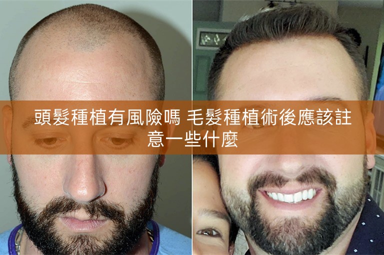 頭髮種植有風險嗎 毛髮種植術後應該註意一些什麼