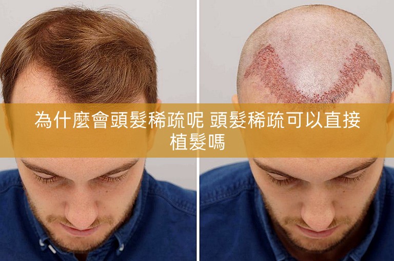 為什麼會頭髮稀疏呢 頭髮稀疏可以直接植髮嗎
