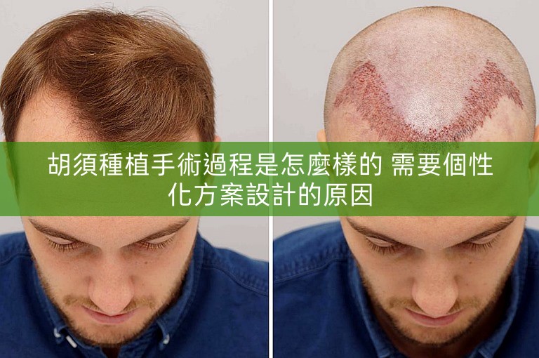 胡須種植手術過程是怎麼樣的 需要個性化方案設計的原因
