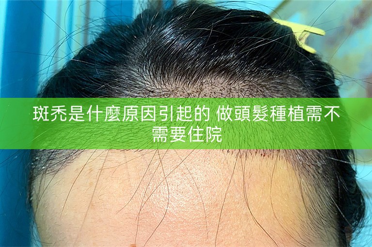 斑禿是什麼原因引起的 做頭髮種植需不需要住院
