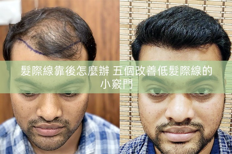 髮際線靠後怎麼辦 五個改善低髮際線的小竅門