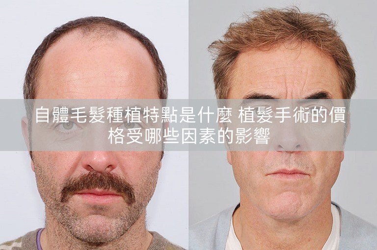 自體毛髮種植特點是什麼 植髮手術的價格受哪些因素的影響