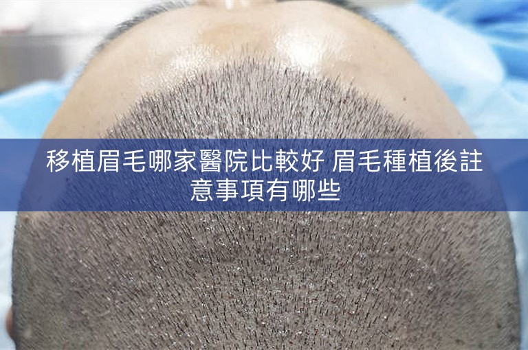 移植眉毛哪家醫院比較好 眉毛種植後註意事項有哪些