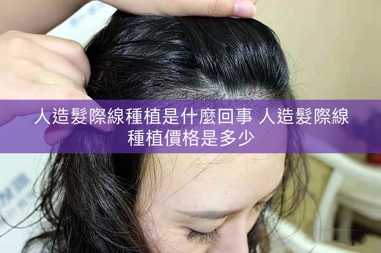 人造髮際線種植是什麼回事 人造髮際線種植價格是多少