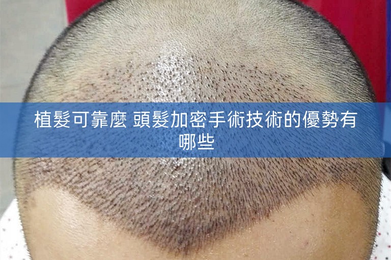植髮可靠麼 頭髮加密手術技術的優勢有哪些