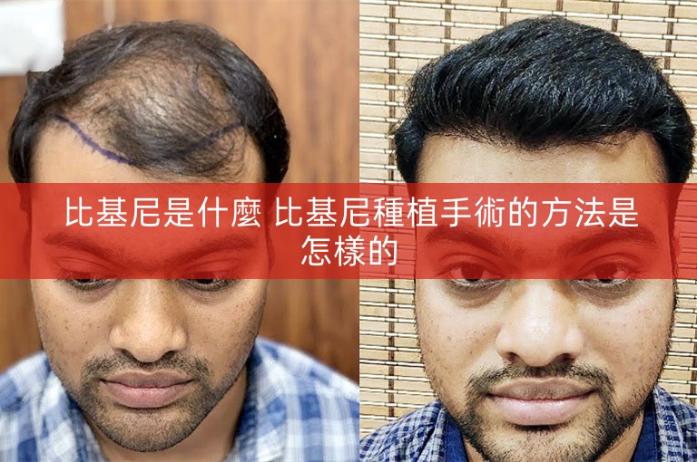 比基尼是什麼 比基尼種植手術的方法是怎樣的