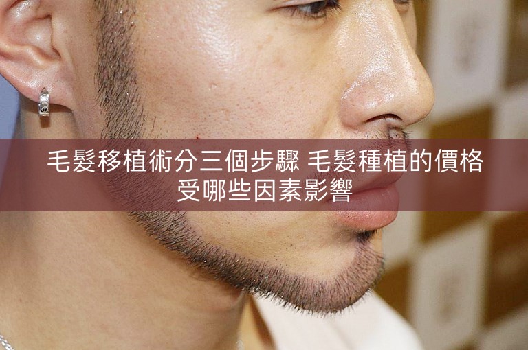毛髮移植術分三個步驟 毛髮種植的價格受哪些因素影響