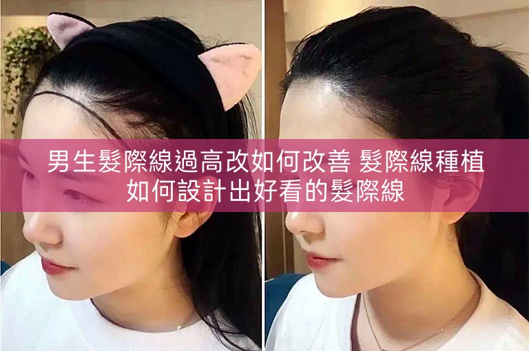 男生髮際線過高改如何改善 髮際線種植如何設計出好看的髮際線