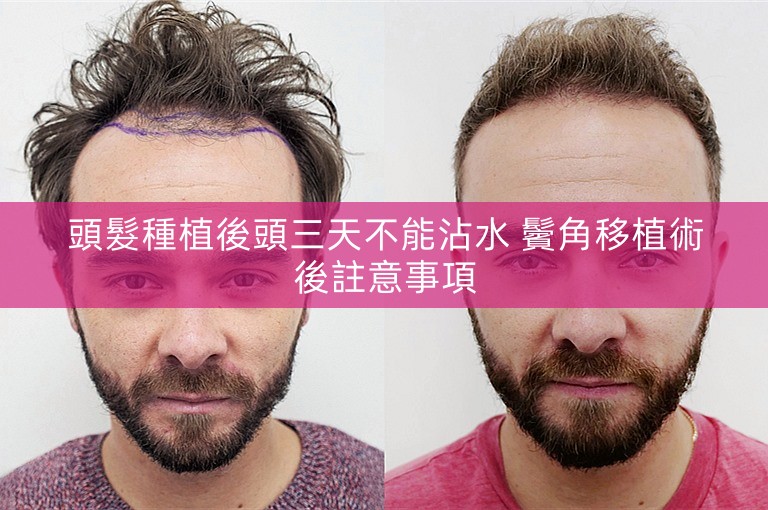 頭髮種植後頭三天不能沾水 鬢角移植術後註意事項