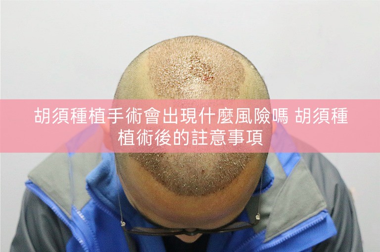 胡須種植手術會出現什麼風險嗎 胡須種植術後的註意事項