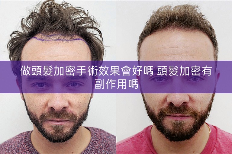 做頭髮加密手術效果會好嗎 頭髮加密有副作用嗎 做頭髮加密手術效果會好嗎 頭髮加密有副作用嗎