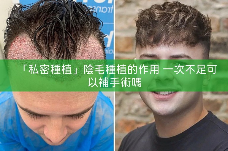 「私密種植」陰毛種植的作用 一次不足可以補手術嗎 「私密種植」陰毛種植的作用 一次不足可以補手術嗎