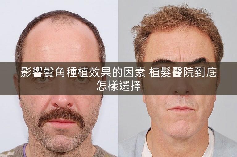 影響鬢角種植效果的因素 植髮醫院到底怎樣選擇
