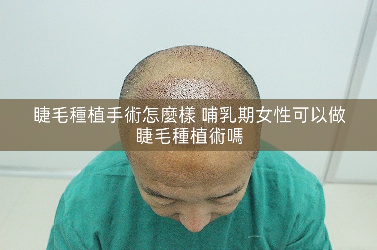 睫毛種植手術怎麼樣 哺乳期女性可以做睫毛種植術嗎