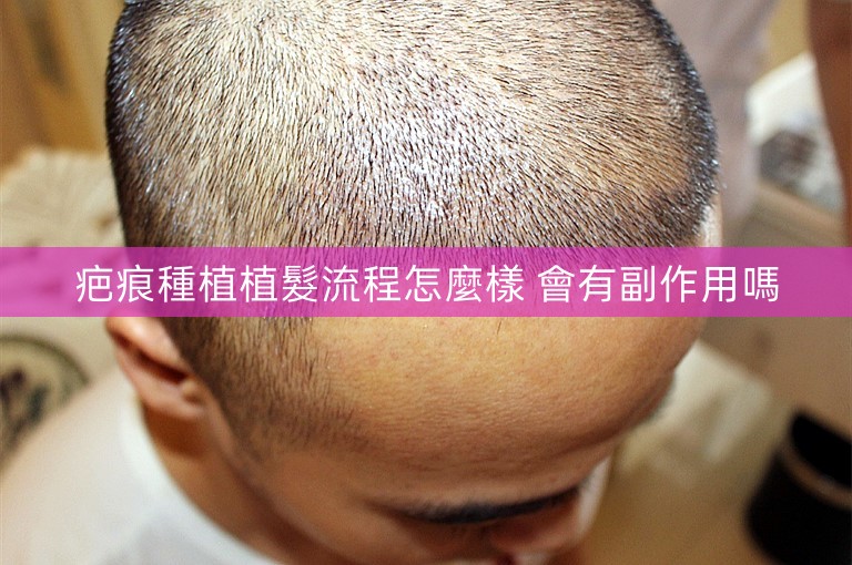 疤痕種植植髮流程怎麼樣 會有副作用嗎