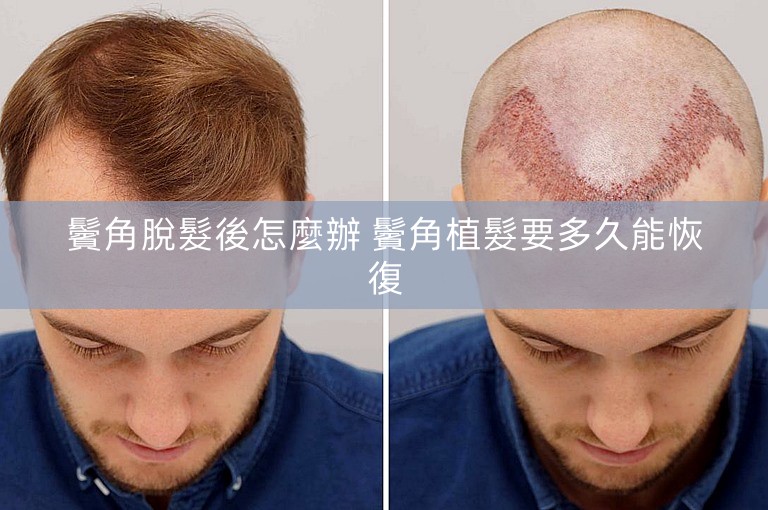 鬢角脫髮後怎麼辦 鬢角植髮要多久能恢復