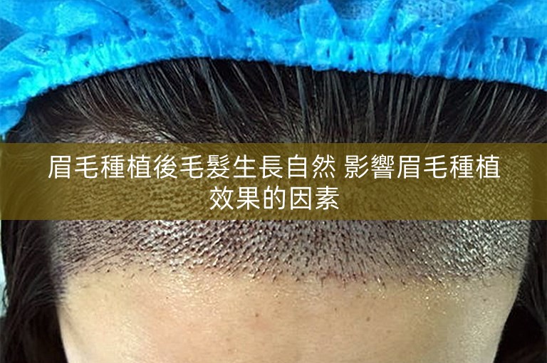 眉毛種植後毛髮生長自然 影響眉毛種植效果的因素