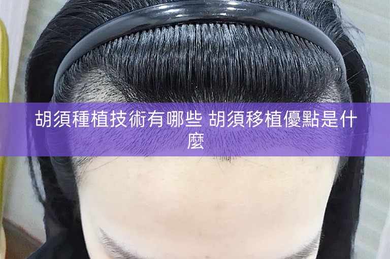 胡須種植技術有哪些 胡須移植優點是什麼