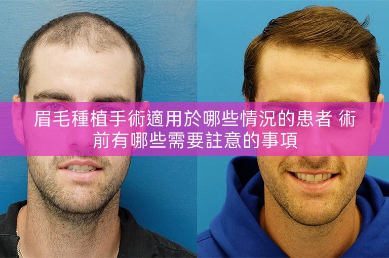 眉毛種植手術適用於哪些情況的患者 術前有哪些需要註意的事項