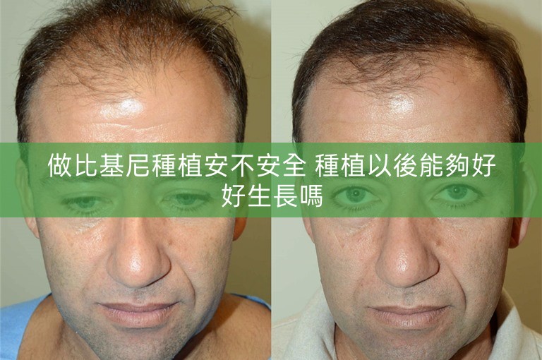 做比基尼種植安不安全 種植以後能夠好好生長嗎